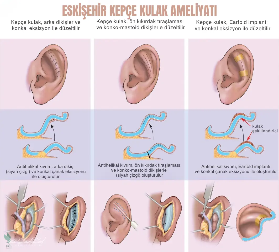 Eskişehir Kepçe Kulak  Estetiği 