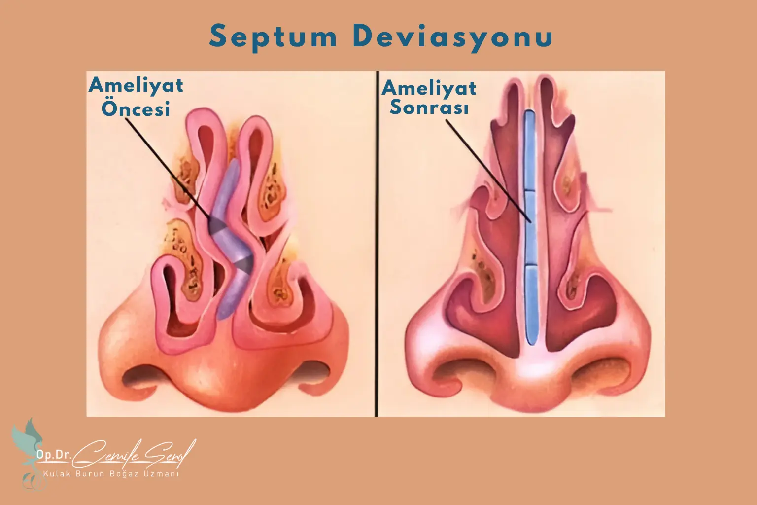 septoplasti ameliyatı öncesi sonrası anatomi eskişehir - Op. Dr. Cemile Şenol