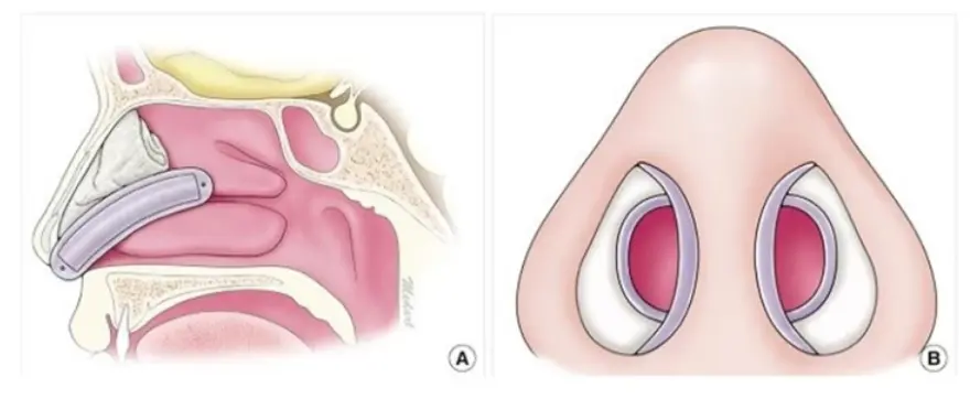 Eskişehir Burun Ameliyatı Silikon Splint ve Tampon Çeşitleri - Op. Dr. Cemile Şenol